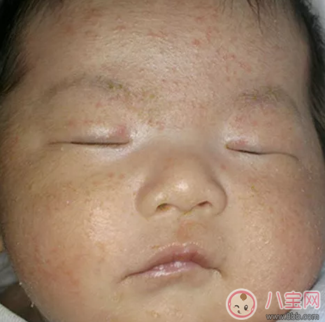 孩子臉上長痤瘡怎么辦 怎么消除孩子的痤瘡