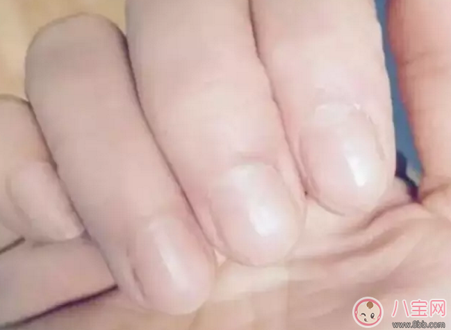 小孩子的手指甲上沒有白月牙是什么原因 小孩沒有白月牙吃什么好