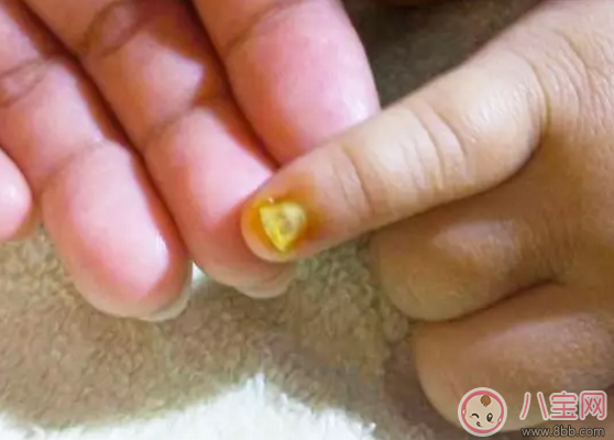 寶寶指甲蓋變成黃色綠色灰色黑色 寶寶指甲蓋變色怎么辦