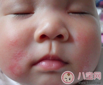 小兒濕疹的癥狀及治療方法 引發濕疹的原因有哪些