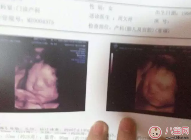 怎么通過(guò)四維彩超分辨男女 四維彩超怎么看比較好