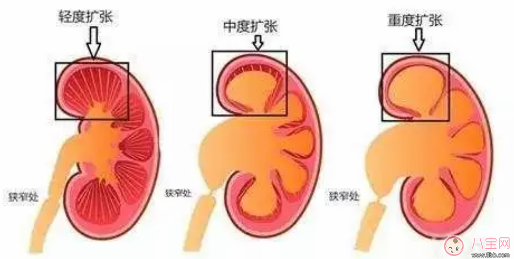 嬰兒腎積水有哪些癥狀   嬰兒腎積水能自愈嗎