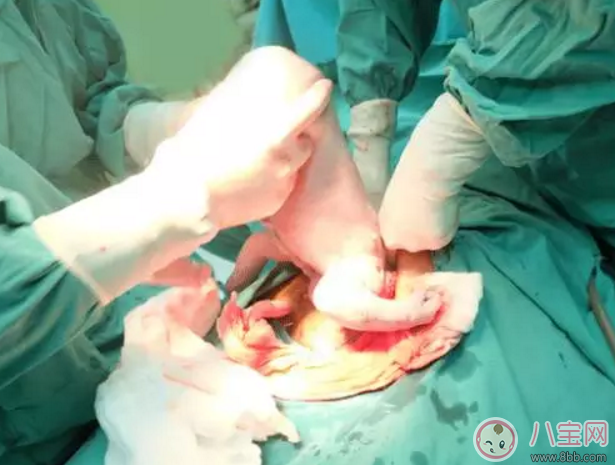 剖腹產(chǎn)產(chǎn)后排尿尿管怎么使用　產(chǎn)后排尿尿管什么時(shí)候能拔掉。