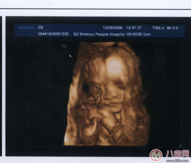 系統彩超和四維的區別 普通彩超和四維哪個要好一些