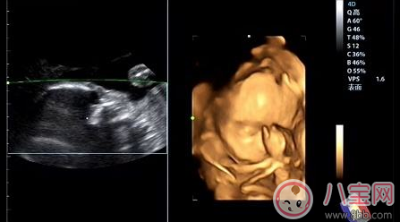 系統彩超和四維的區別 普通彩超和四維哪個要好一些