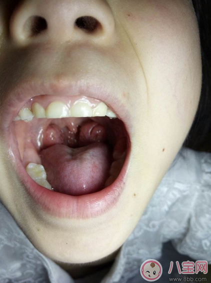 孩子扁桃體炎反復(fù)可以切了嗎 孩子經(jīng)常得扁桃體炎怎么辦