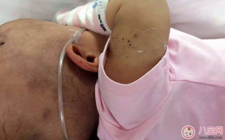 石骨癥是怎么引起的 石骨癥能治好嗎