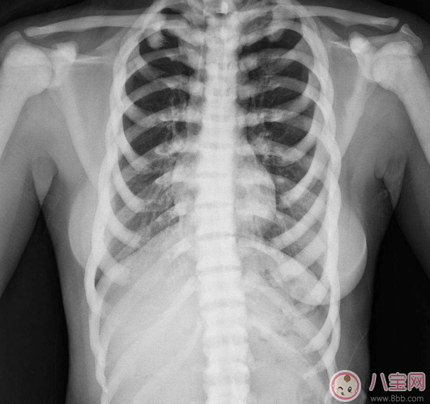 石骨癥是怎么引起的 石骨癥能治好嗎