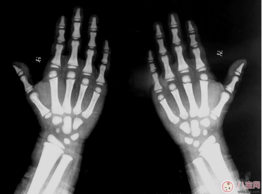 石骨癥是怎么引起的 石骨癥能治好嗎