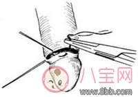 男性包皮手術后多久可以拆紗布 包皮手術后多久可以恢復性生活