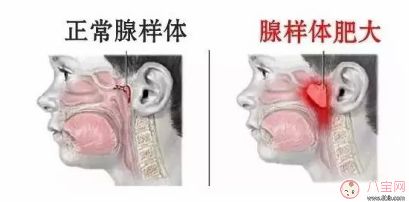 孩子睡覺張嘴打呼嚕怎么回事  寶寶睡覺張嘴打呼嚕怎么辦