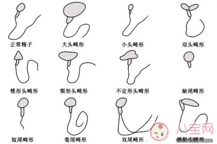 精子畸形率高能懷孕嗎 精子畸形率高怎么辦 精子畸形率高能懷孕嗎 精子畸形率高怎么辦