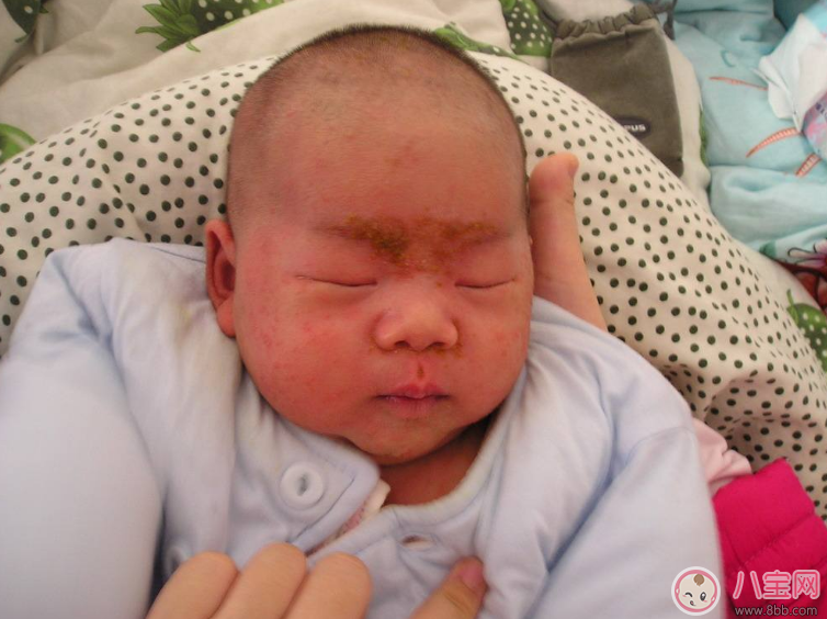 新生兒敗血癥能治好嗎 新生兒敗血癥要治療多久