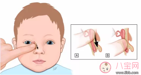 新生兒淚囊炎是什么病 孩子的眼屎應該怎么清理比較好