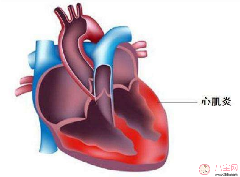 病毒性心肌炎嚴重嗎 小孩爆發性心肌炎很坑醫生嗎