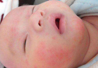 寶寶濕疹怎么預(yù)防2018 寶寶濕疹三大預(yù)防措施