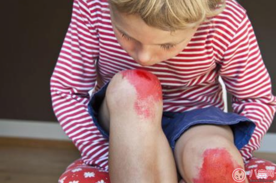 寶寶擦傷需要用創可貼嗎 孩子擦傷應該如何處理