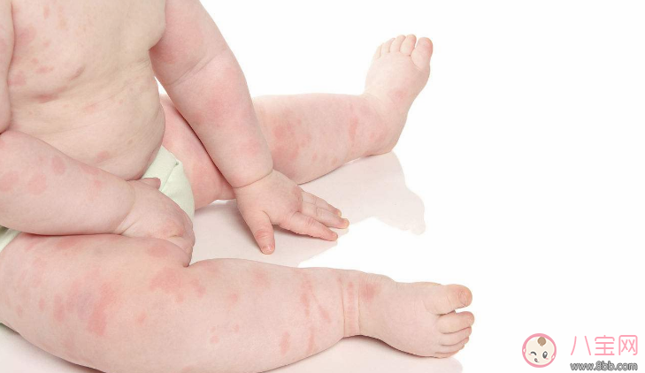 寶寶吃阿莫西林過敏癥狀 2歲寶寶服用阿莫西林過敏怎么辦 寶寶吃阿莫西林過敏癥狀 2歲寶寶服用阿莫西林過敏怎么辦