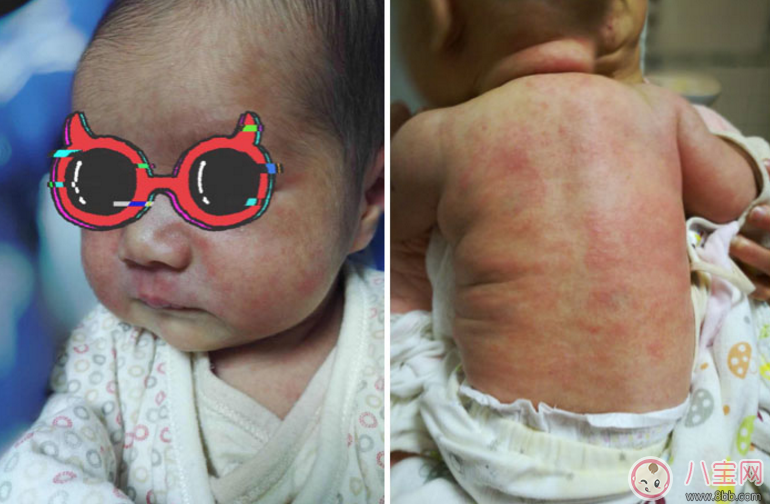 母乳過敏怎么辦2018 母乳過敏的癥狀有哪些 母乳過敏怎么辦2018 母乳過敏的癥狀有哪些