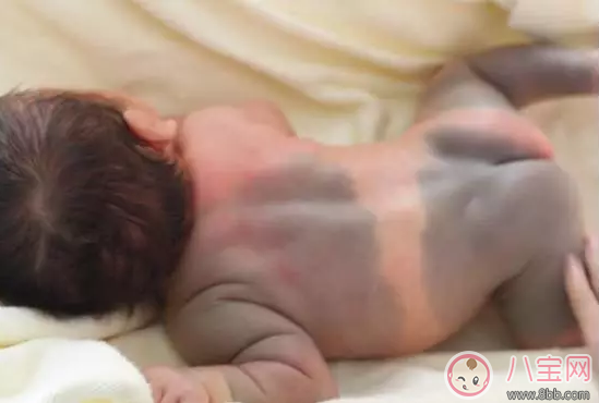 孩子長胎記是好還是壞 孩子身上有哪些胎記要去治療