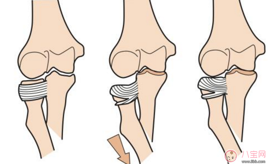 孩子得扯肘癥怎么辦 孩子脫臼了之后應(yīng)該怎么治療