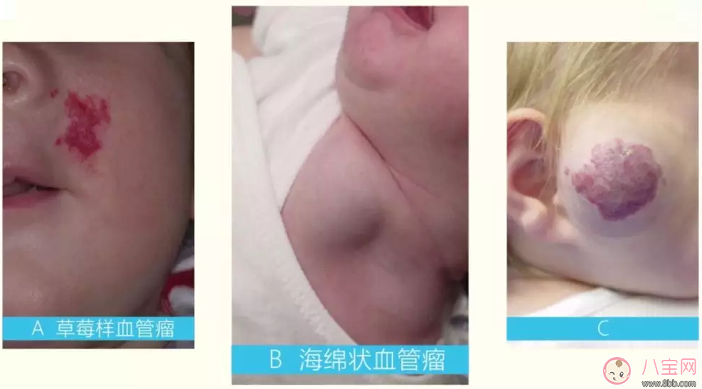 寶寶身上的紅印子是什么東西 孩子身上長紅色的塊狀東西是什么 寶寶身上的紅印子是什么東西 孩子身上長紅色的塊狀東西是什么