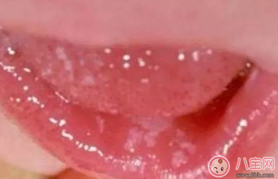 寶寶長鵝口瘡會影響吃奶嗎 新生兒長鵝口瘡用什么藥