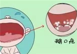 寶寶長鵝口瘡會影響吃奶嗎 新生兒長鵝口瘡用什么藥