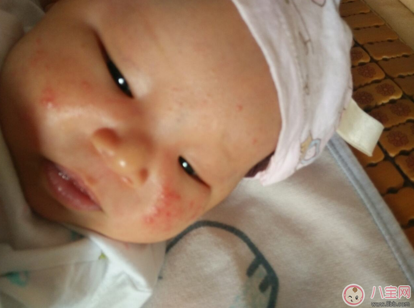 孩子的濕疹總是不好怎么辦 孩子濕疹總是不好的原因是什么