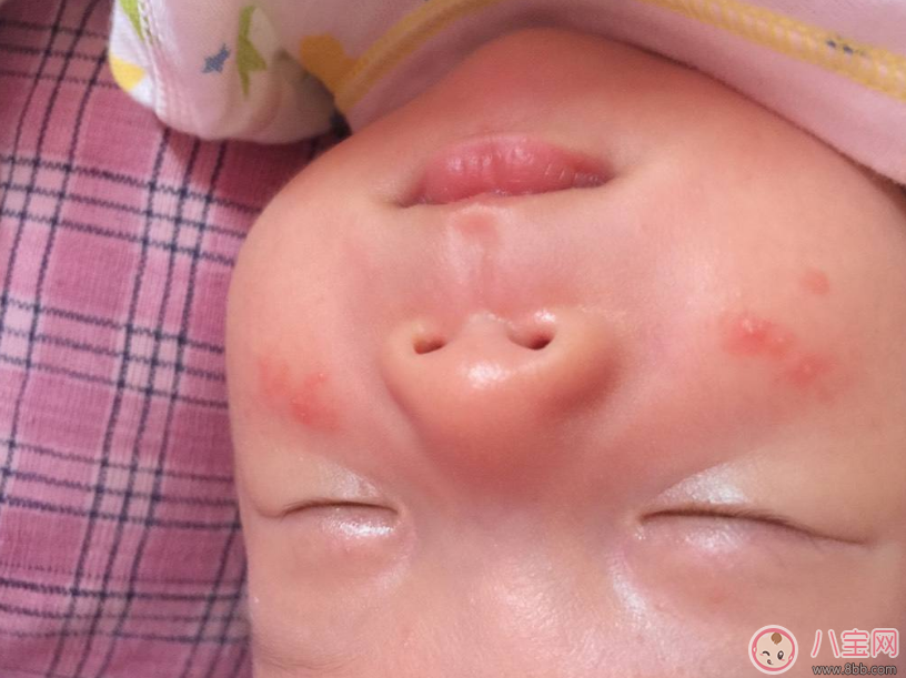 孩子的濕疹總是不好怎么辦 孩子濕疹總是不好的原因是什么