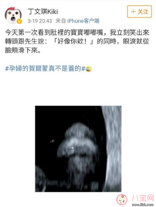 丁文琪B超照寶寶嘴唇像林宥嘉 B超寶寶長相和生下來有區別嗎