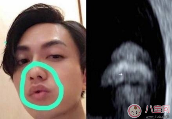 丁文琪B超照寶寶嘴唇像林宥嘉 B超寶寶長相和生下來有區別嗎