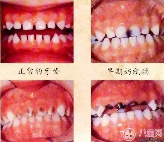 寶寶奶瓶齲的危害有哪些 寶寶奶瓶齲怎么預防2018