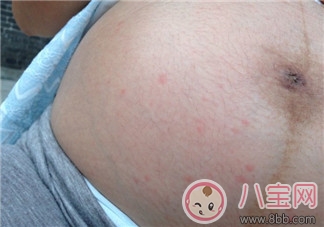 妊娠紋前兆是紅點點嗎 妊娠紋是長什么樣子初期圖片