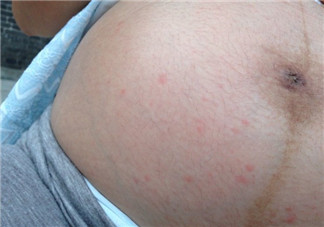 妊娠紋前兆是紅點(diǎn)點(diǎn)嗎 妊娠紋是長什么樣子初期圖片