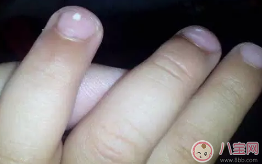寶寶指甲上有白色斑點怎么回事 小孩指甲上有白色斑點是什么病