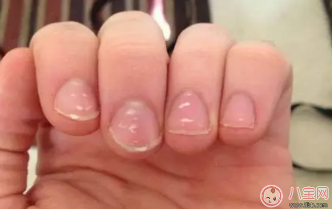 寶寶指甲上有白色斑點怎么回事 小孩指甲上有白色斑點是什么病