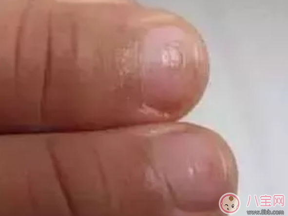 小孩指甲有一個凹陷的小窩怎么辦 寶寶手指蓋上長小凹窩是什么原因 小孩指甲有一個凹陷的小窩怎么辦 寶寶手指蓋上長小凹窩是什么原因