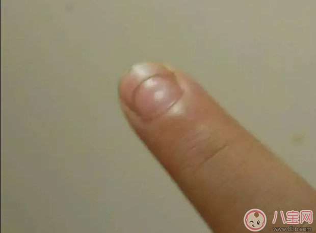 寶寶指甲上有白色的橫線怎么辦 寶寶指甲白色橫線吃什么好 寶寶指甲上有白色的橫線怎么辦 寶寶指甲白色橫線吃什么好