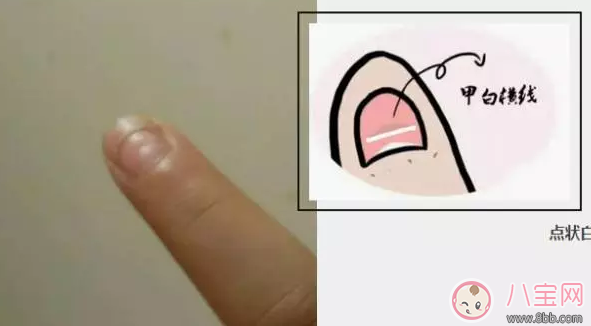 寶寶指甲上有白色的橫線怎么辦 寶寶指甲白色橫線吃什么好 寶寶指甲上有白色的橫線怎么辦 寶寶指甲白色橫線吃什么好
