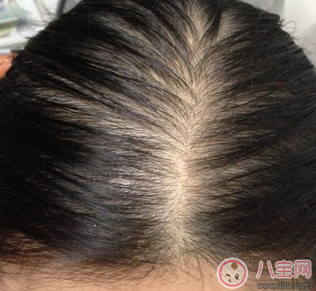 產后脫發會持續多久 為什么產后脫發嚴重