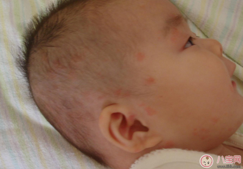 小孩濕疹反復(fù)怎么辦 濕疹為什么會(huì)反復(fù)發(fā)作