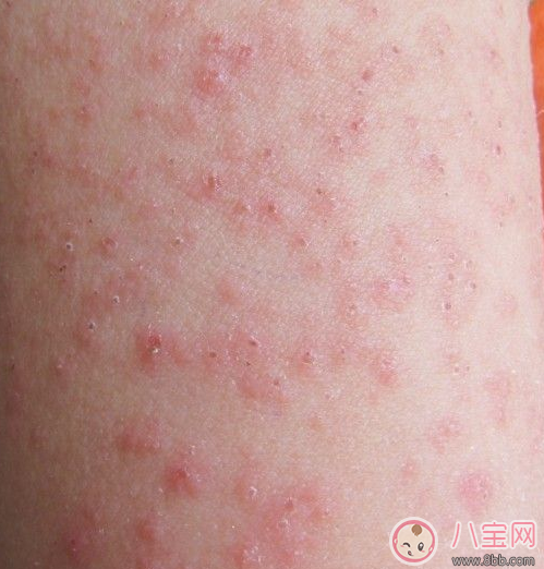 孩子得麻疹怎么根治 孩子得麻疹怎么治比較好