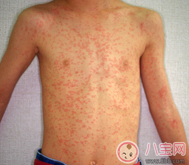 孩子得麻疹怎么根治 孩子得麻疹怎么治比較好