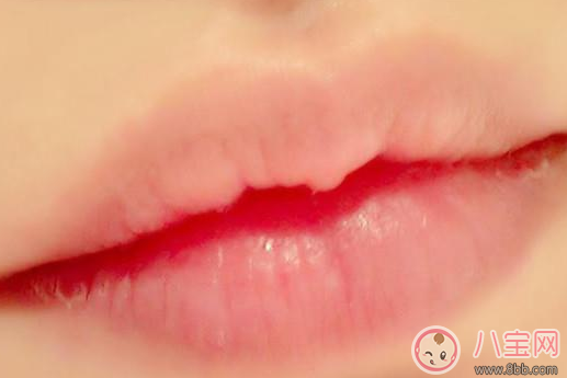 嘴巴起皮是上火了嗎 嘴巴老是干起皮怎么辦