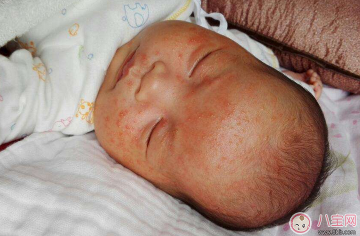 寶寶濕疹反復(fù)發(fā)作怎么辦 濕疹為什么會反復(fù)發(fā)作