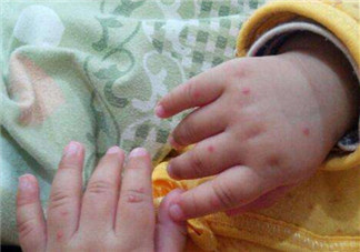 手足口病結痂還會傳染嗎 手足口病一般幾天能好