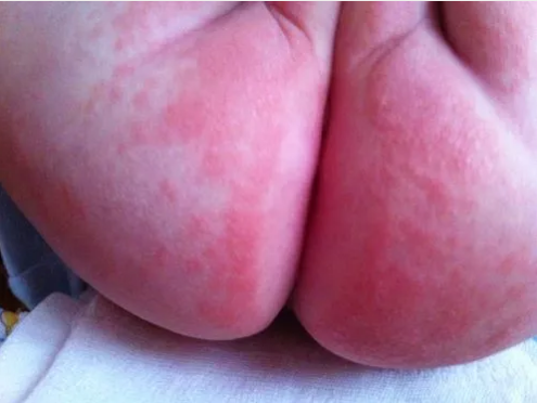 寶寶尿布疹是什么樣子的 孩子尿布疹怎么護理治療2018