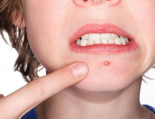 下巴長痘是什么原因 下巴長痘跟哪些婦科病癥有關(guān)