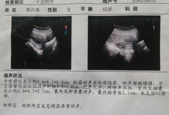 胎停育后能成功保胎嗎2018 有胎停育保胎成功經(jīng)驗嗎